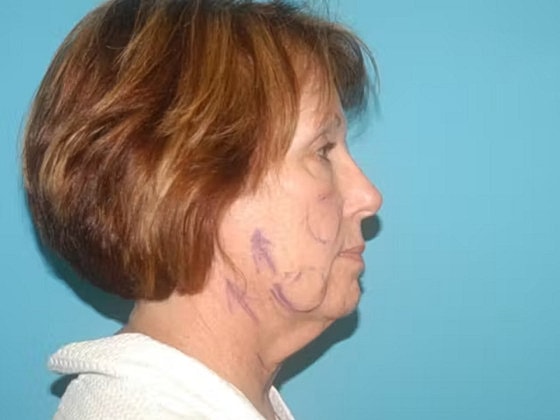 Facelift Before & After