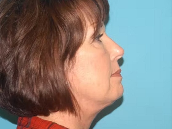 Facelift Before & After