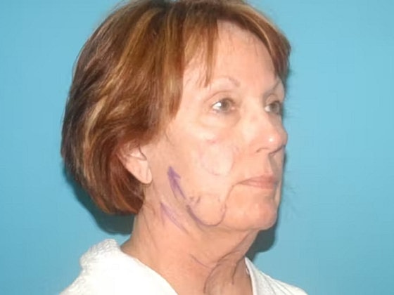 Facelift Before & After