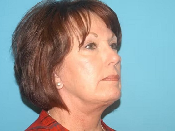 Facelift Before & After