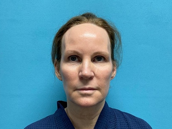 Facelift Before & After