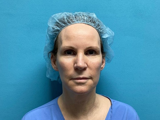 Facelift Before & After
