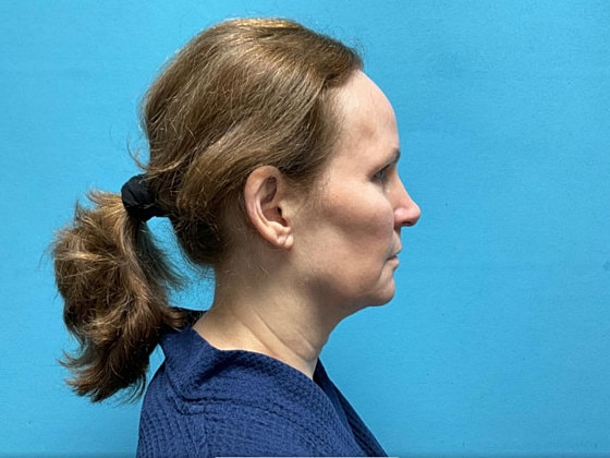 Facelift Before & After