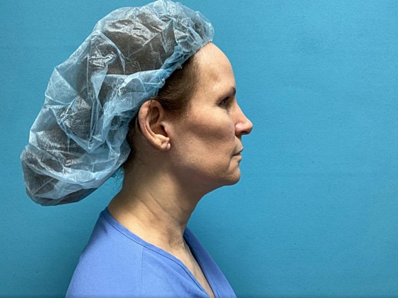 Facelift Before & After
