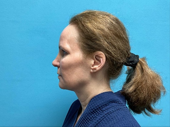 Facelift Before & After