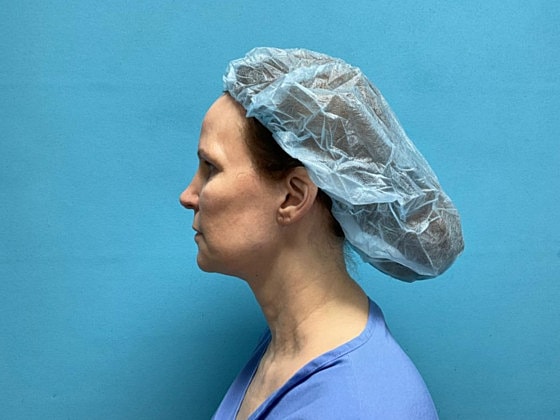 Facelift Before & After