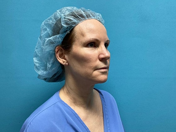 Facelift Before & After