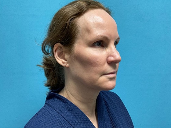 Facelift Before & After