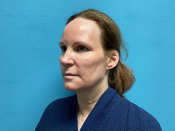 Facelift Before & After