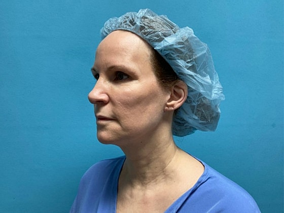 Facelift Before & After