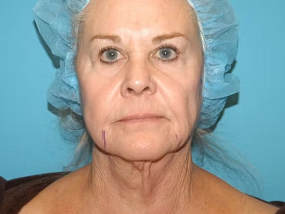 Facelift Before & After