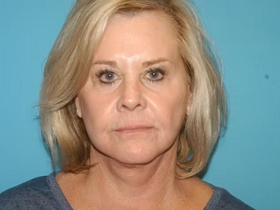 Facelift Before & After