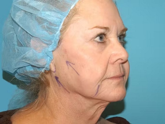 Facelift Before & After