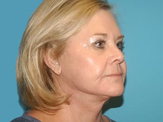 Facelift Before & After