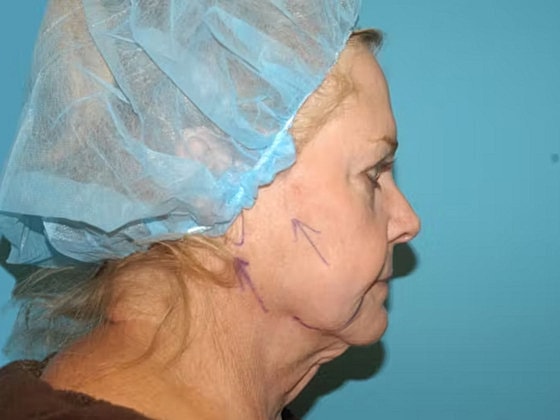 Facelift Before & After