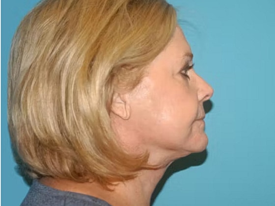 Facelift Before & After