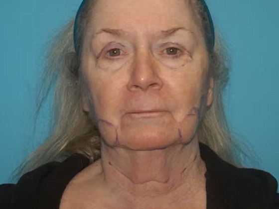 Facelift Before & After