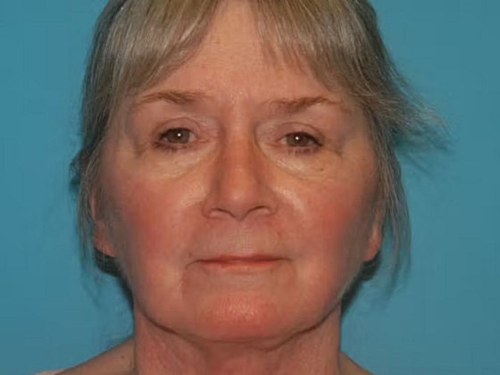 Facelift Before & After