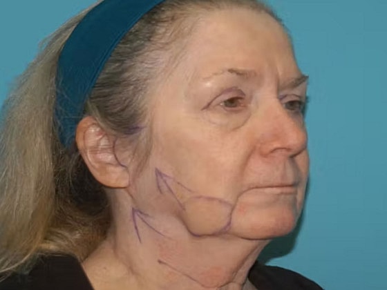 Facelift Before & After