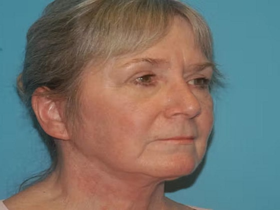 Facelift Before & After