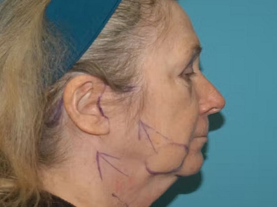 Facelift Before & After