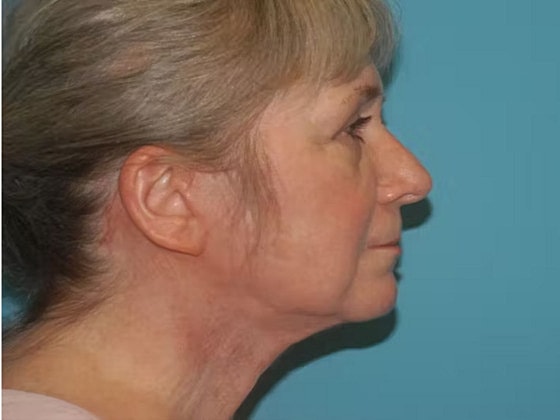 Facelift Before & After