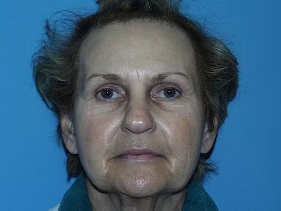 Facelift Before & After