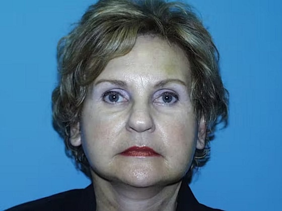 Facelift Before & After