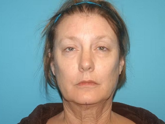 Facelift Before & After