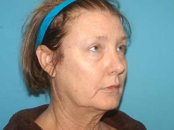 Facelift Before & After