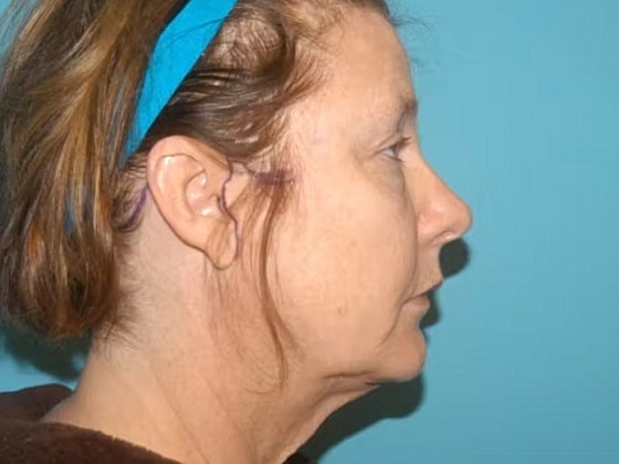 Facelift Before & After