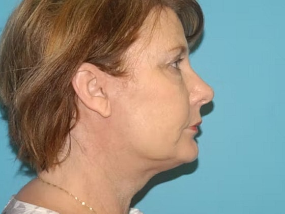Facelift Before & After