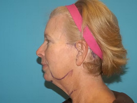 Facelift Before & After