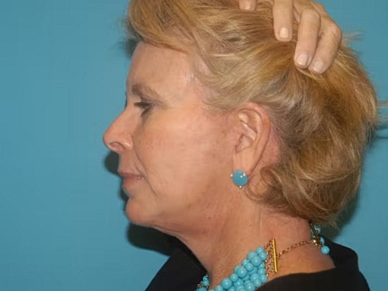 Facelift Before & After