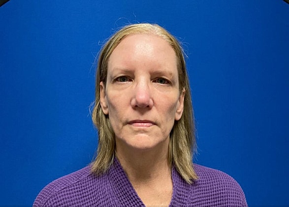 Facelift Before & After
