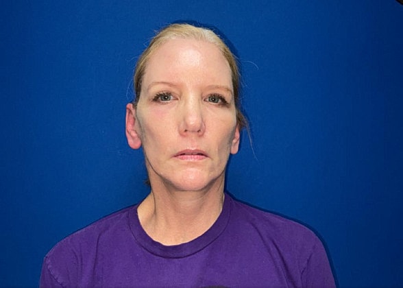 Facelift Before & After