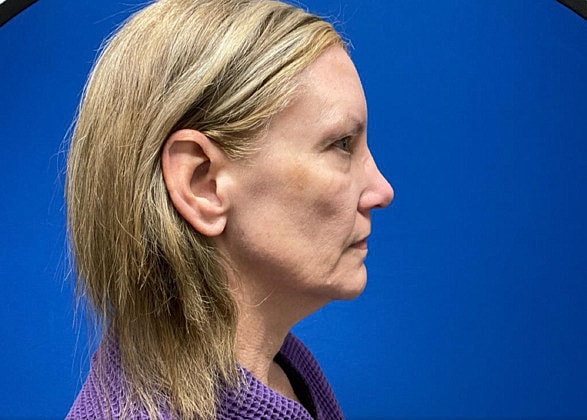 Facelift Before & After