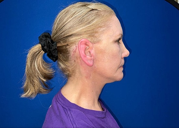 Facelift Before & After