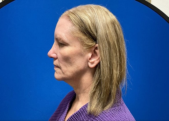 Facelift Before & After