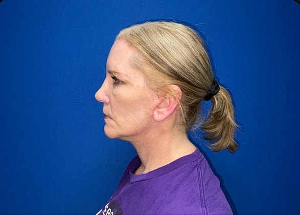 Facelift Before & After