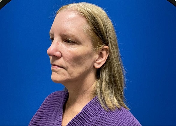 Facelift Before & After
