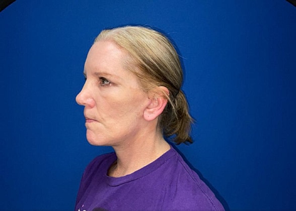 Facelift Before & After