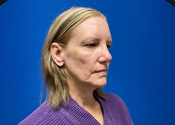 Facelift Before & After
