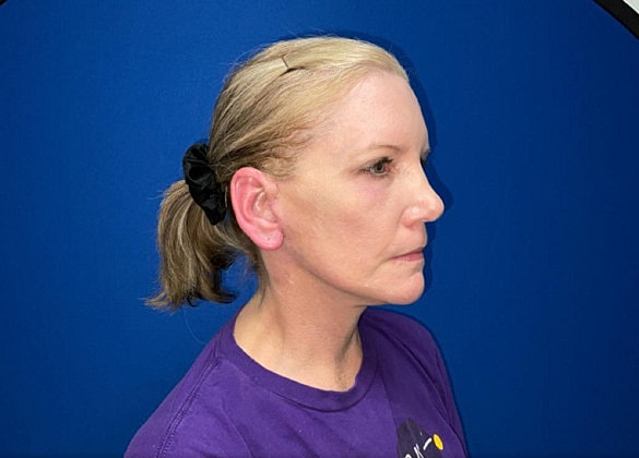 Facelift Before & After