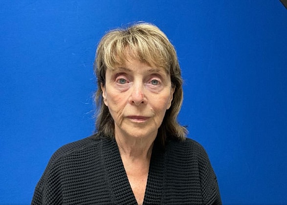 Facelift Before & After