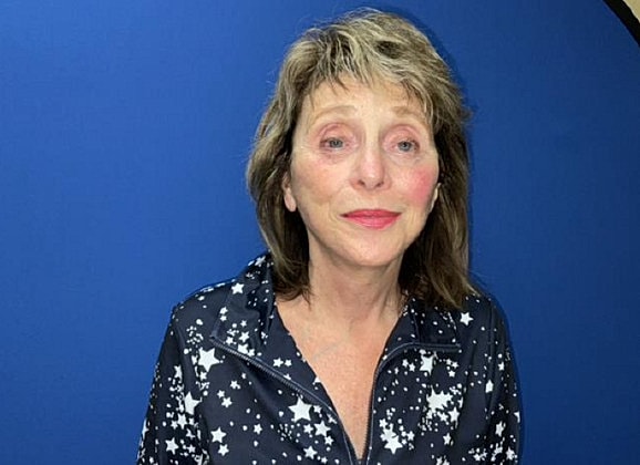 Facelift Before & After
