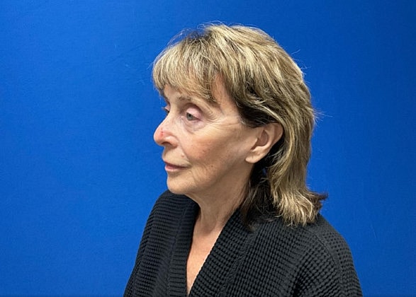 Facelift Before & After