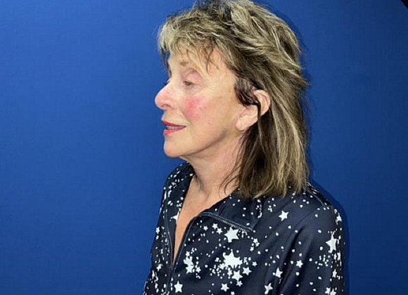 Facelift Before & After
