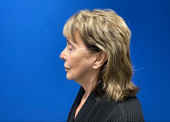 Facelift Before & After