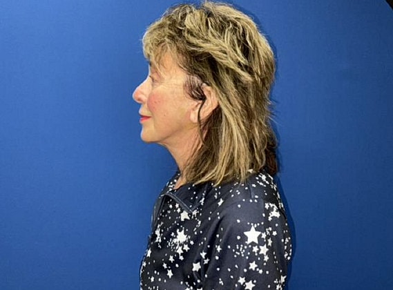 Facelift Before & After